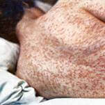 Big Year for Measles: U.S. Cases Surpass 2025, Most in 35 Years